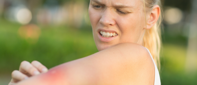 Donna all’aperto osserva una puntura sul braccio, simbolo di prurito, rossore e irritazione causati dagli insetti in estate.